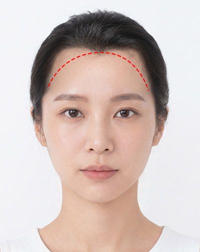얼굴형과 측면라인을 고려한 모제림 디자인 교정