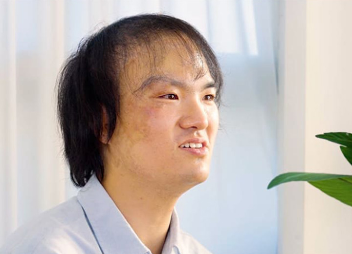 모제림 흉터 모발이식