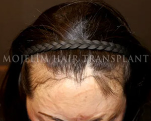 Case 2. 화상으로 인한 흉터(두피)