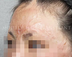 Case 3. 화상으로 인한 흉터(기타-눈썹)