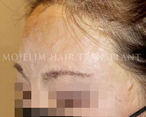 Case 3. 화상으로 인한 흉터(기타-눈썹)