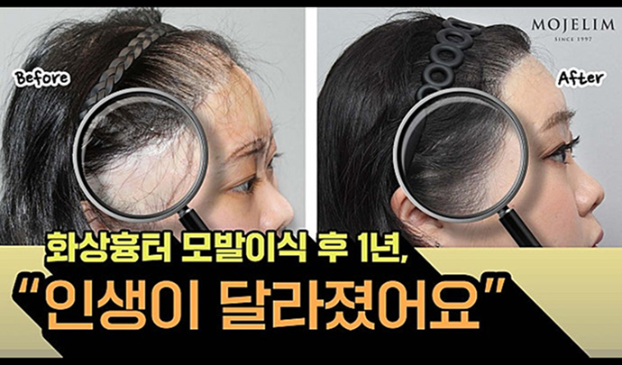 흉터모발이식 온택트
