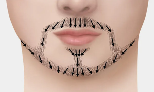 수염 성장 방향을 살린 이식