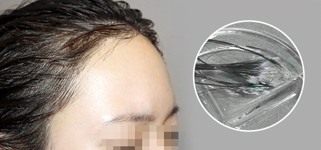 긴 이식모가 이식 부위를 덮는 참고 사진
