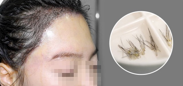 짧게 자른 이식모로 이식한 부위 참고 사진