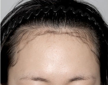 정면 · 롱헤어 이식 수술 전
