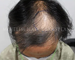 Case 2. 화상으로 인한 흉터(두피)