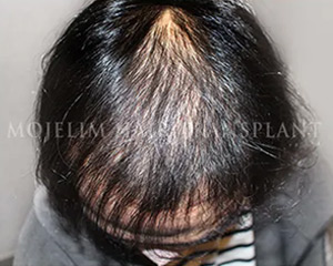 Case 2. 화상으로 인한 흉터(두피)
