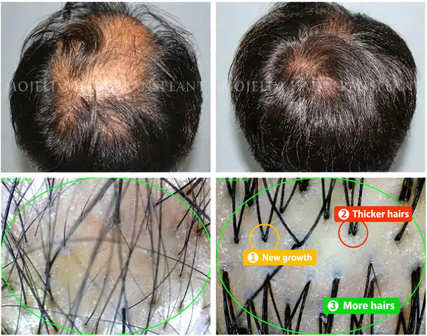Men — 9 months of MOJELIM hair-loss treatment