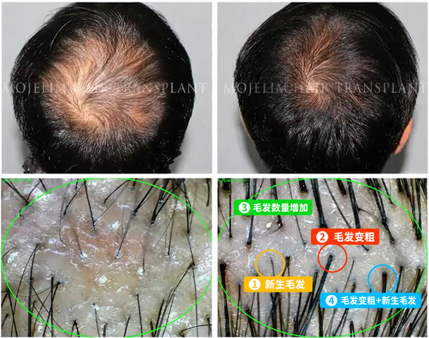 男性 — 毛杰琳脱发治疗 5个月
