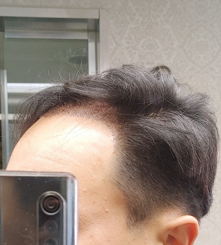 실제 경과 (5일경과) 추천