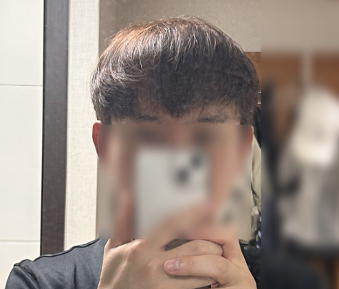 40대 남 비절개 모발이식 4주차